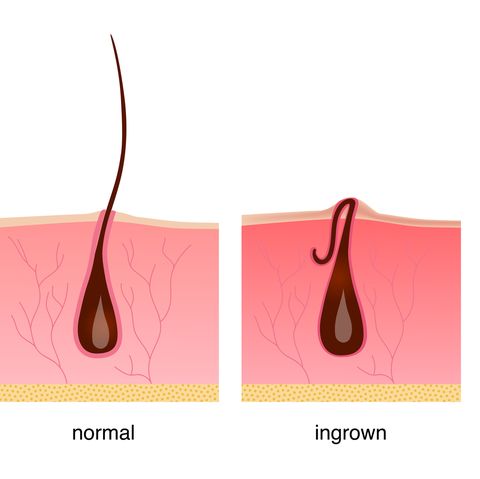 How To Get Rid Of An Ingrown Hair Ingrown Hair Removal Tips