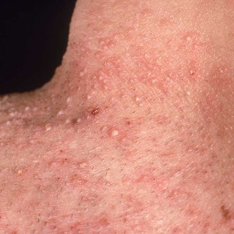 Skin Bumps | Prevention