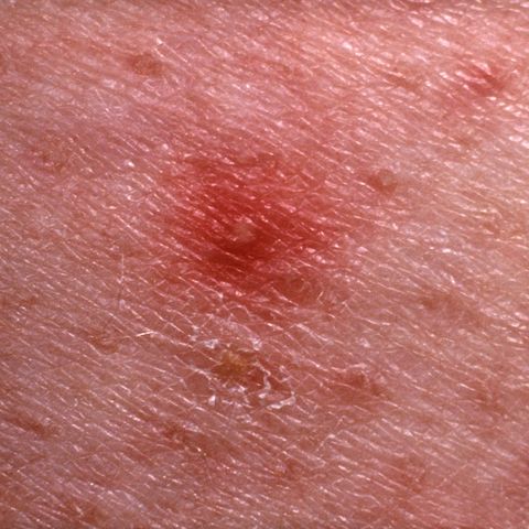 A Guide To Raised Bumps On Your Skin - Red Moles, Brown 