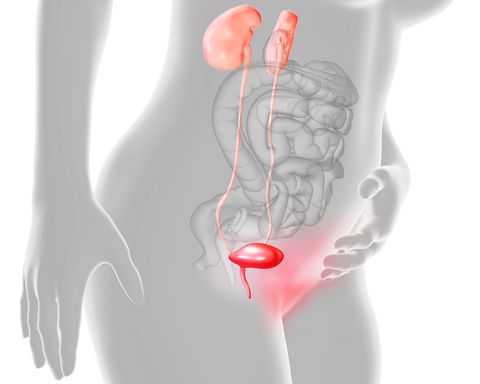 cystitis, conceptual illustration cystitis is inflammation of the bladder, usually caused by an infection