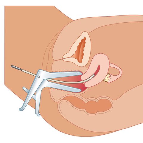 cervical biopsy