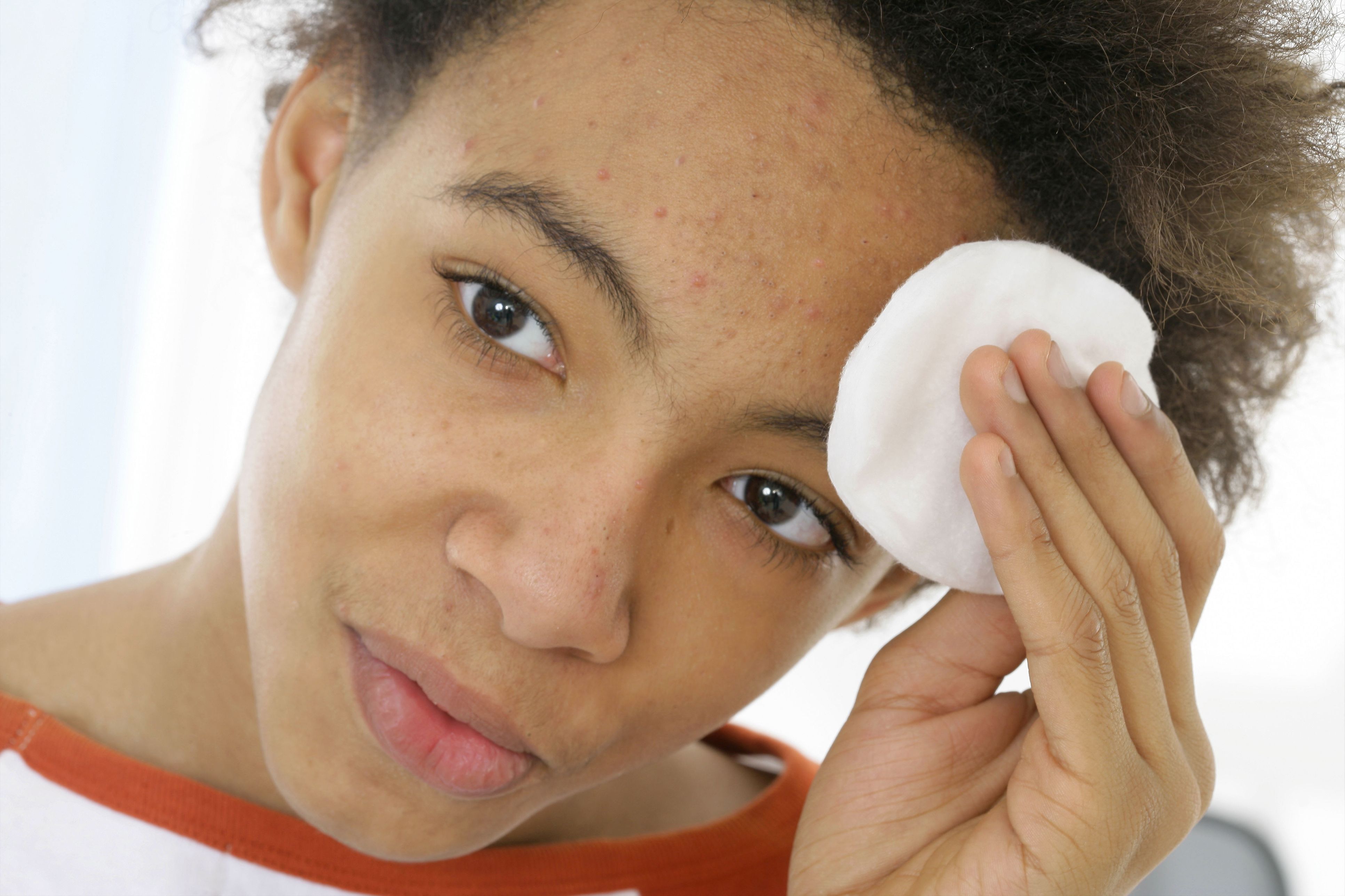 what acne treatments actually work