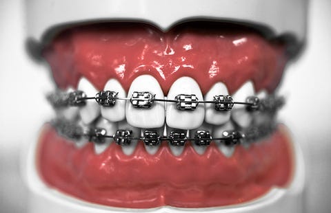 extensive dental work