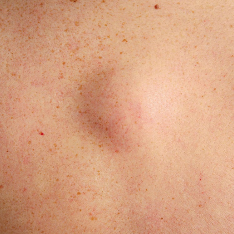 A Guide To Raised Bumps On Your Skin Red Moles Brown Spots Cysts