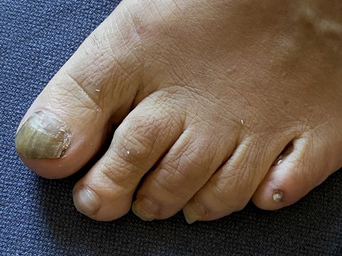 adolescentes Apuesta Arbitraje Cómo eliminar los hongos en las uñas de los pies
