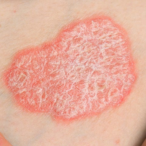 psoriasis, dermatologic diseases