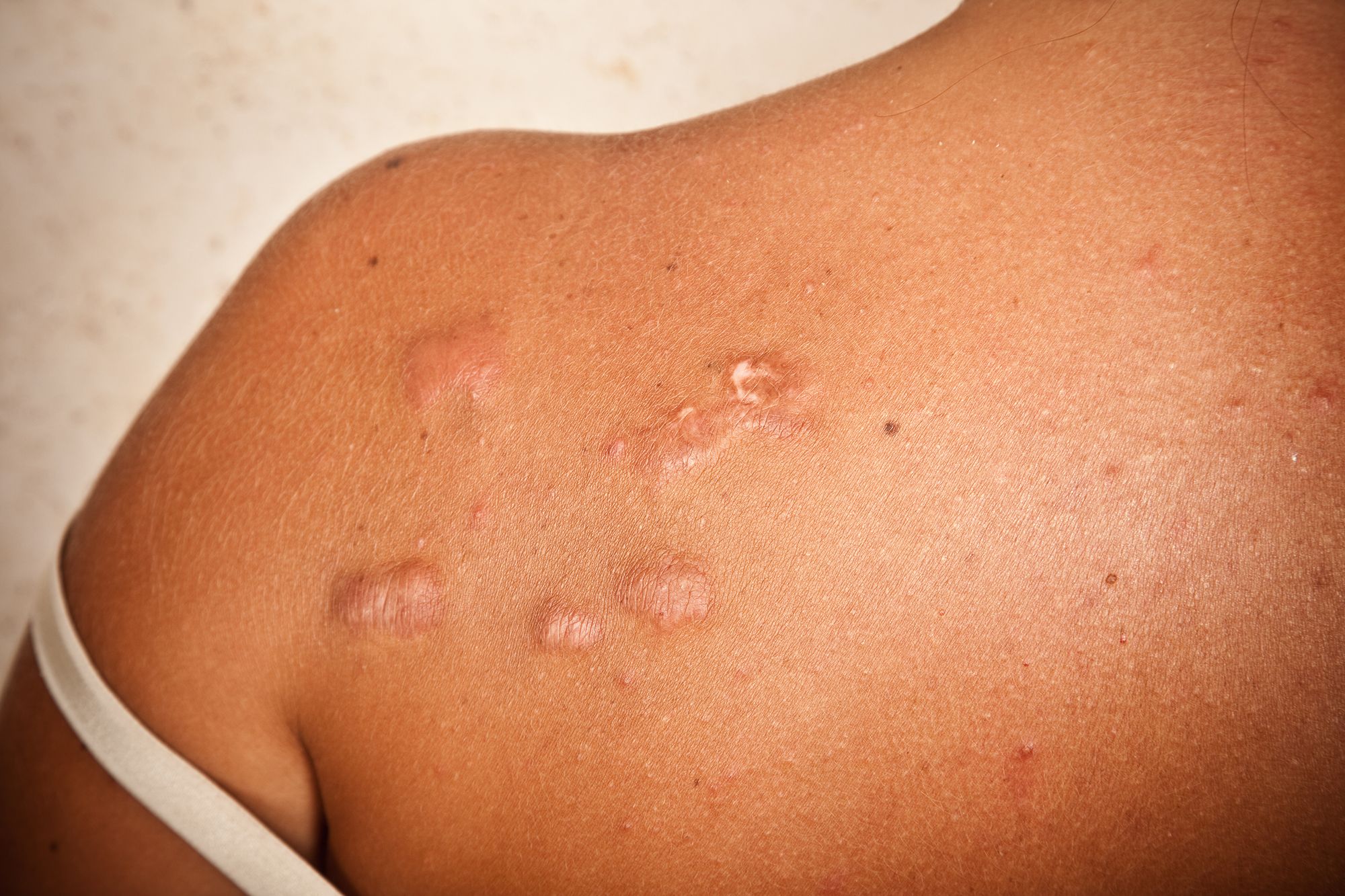 Keloids - What They Are, Causes + How To Get Rid Of Keloid Scars