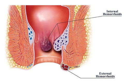 Hemorrhoids meaning