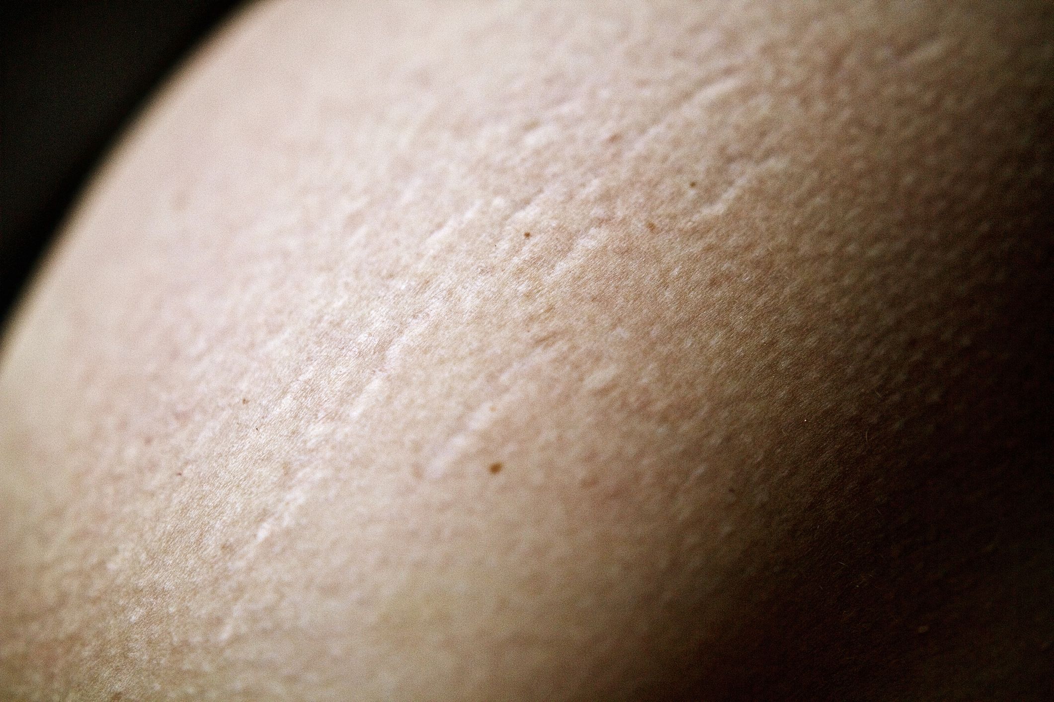 Are Stretch Marks Inevitable When You Lose Weight?