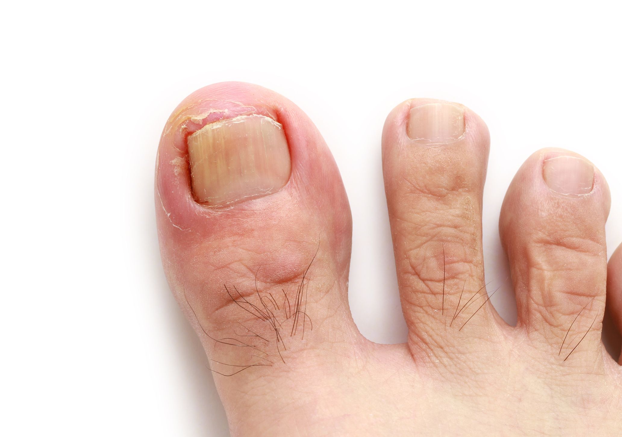 How To Get Rid Of An Ingrown Toenail How To Fix Ingrown Toenail