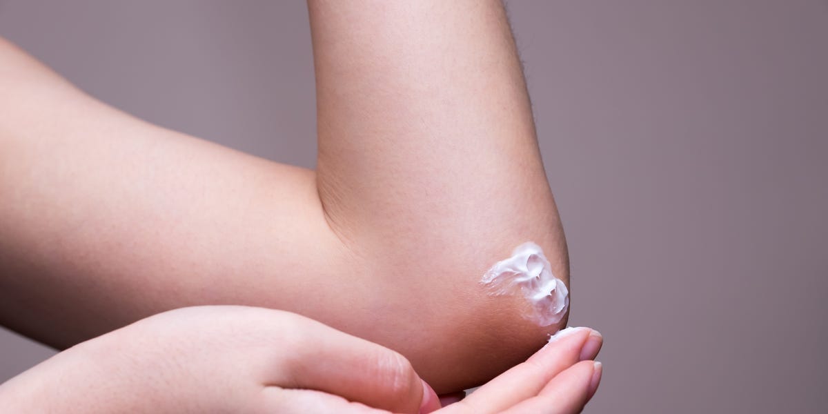 5 eczema triggers and how to avoid them