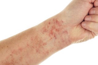 itchy rash on wrist that comes and goes