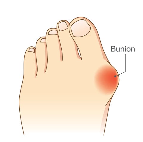 bunion