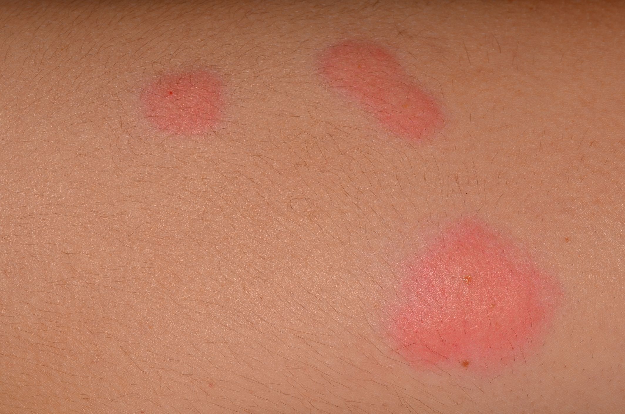 small red bug bites that itch