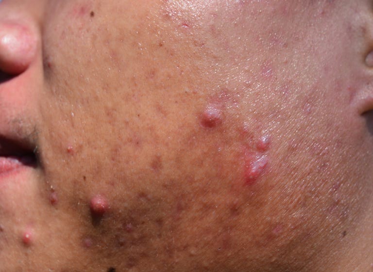 acne sulla pelle del viso