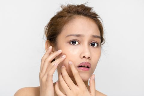 美容皮膚科医が徹底解説 症状別ニキビの原因と対処法
