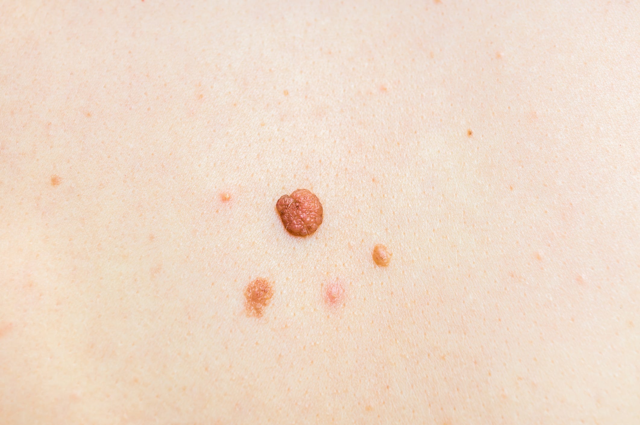 skin cancer pictures