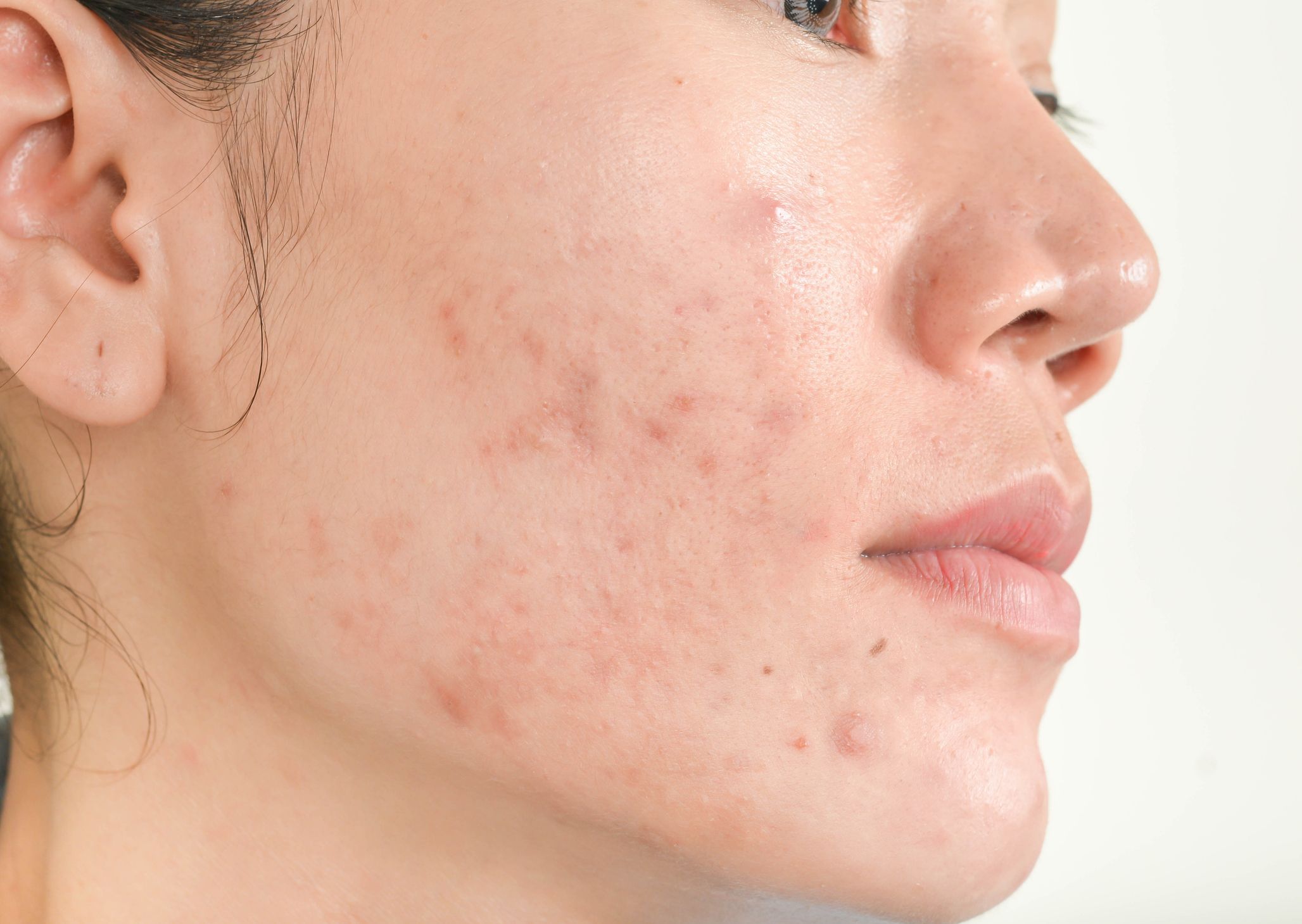 6 Adult Acne Causes And How To Get Rid Of It Say Dermatologists