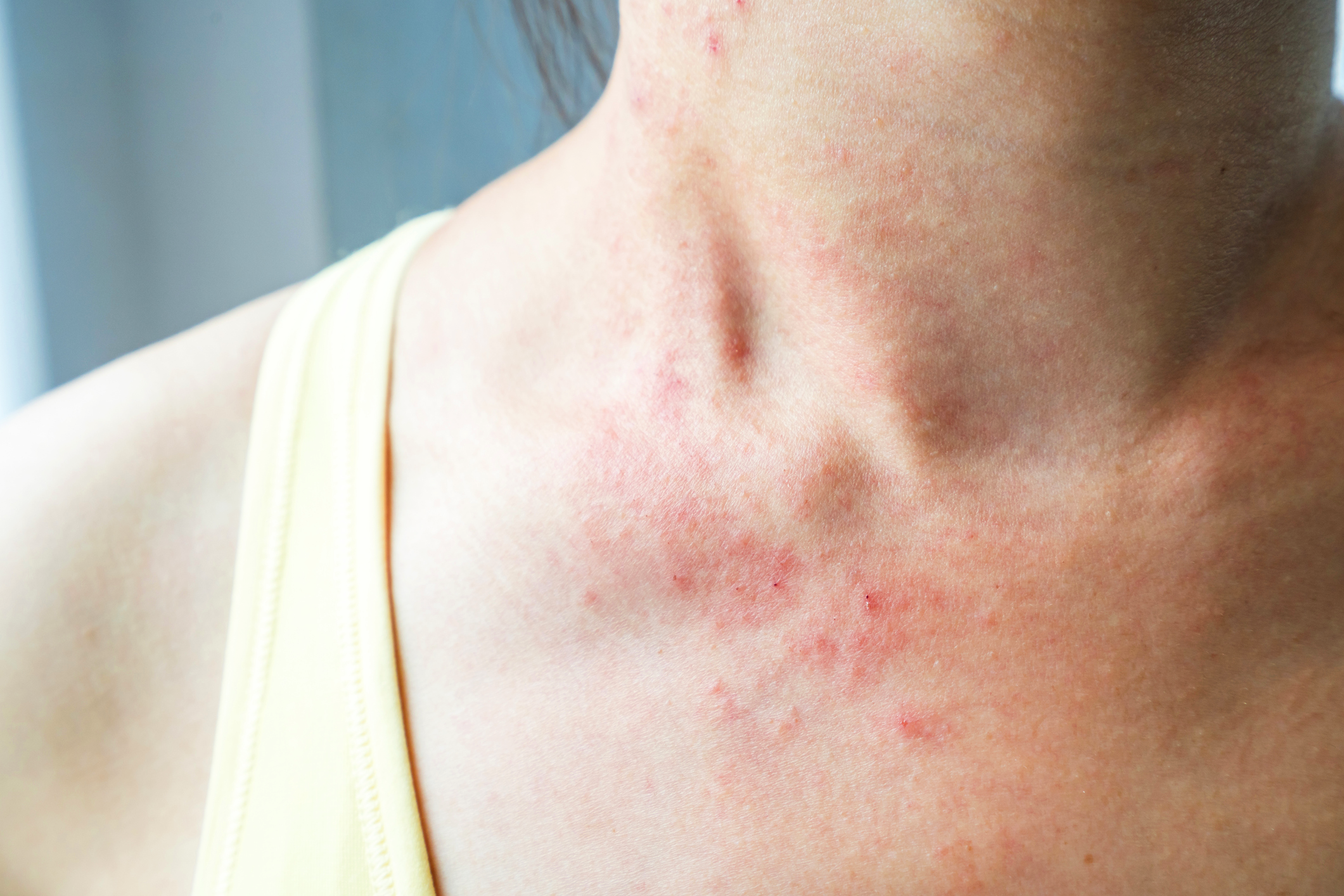 causes of rash purple