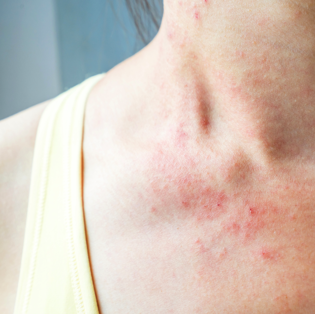 18 Common Skin Rash Pictures How To Id Skin Rash Symptoms