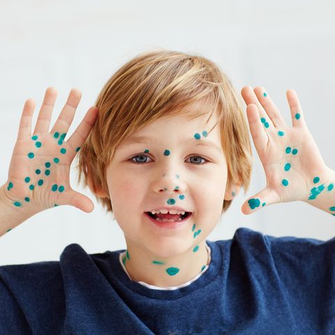 cute young boy, kid having chicken pox, that is cured with brilliant green antiseptic