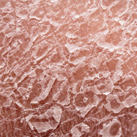 Krém Basma psoriasis