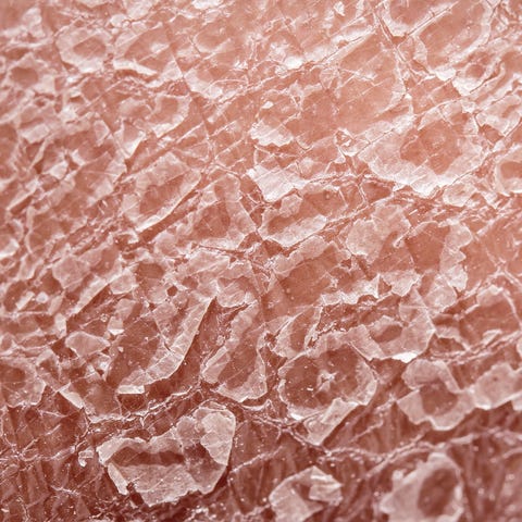 psoriasis skin peeling off