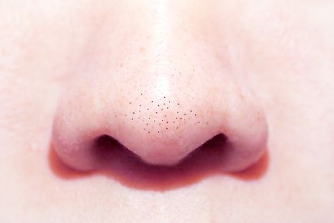 close up macro of many acne small blackhead pimples on the nose
