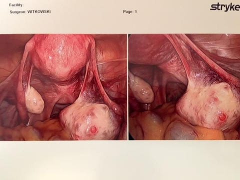 My Period Pain Was Unbearable - How to Treat a Dermoid Cyst My Period Pain Was Unbearable - How to Treat a Dermoid Cyst