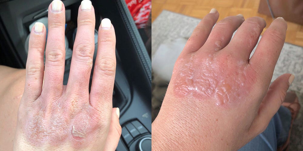 What Is Margarita Burn? The Painful Skin Reaction You Need to Know About This Summer