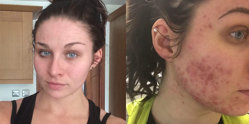 Woman Developed Acne Overnight 