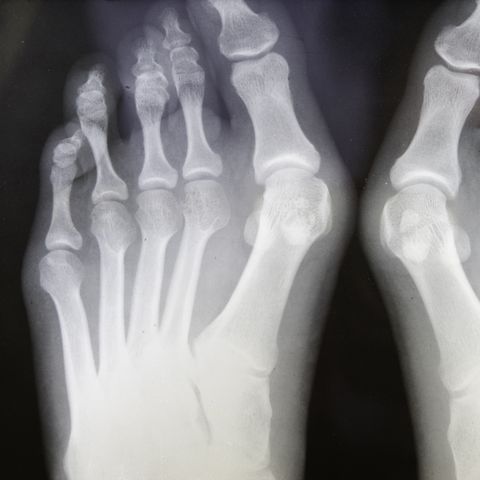 grungy x ray of feet with bunions
