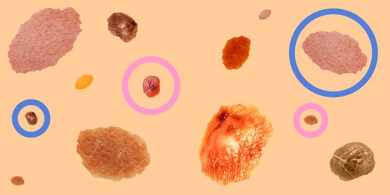 Guide To Moles And Skin Cancer How To Spot Cancerous Moles