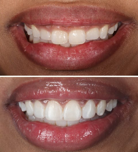 What is gum contouring?