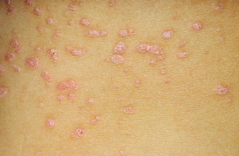 5 Types of Psoriasis - Psoriasis Pictures