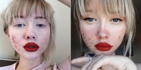 This Woman Has The Most Inspiring Message For Others Struggling With Acne