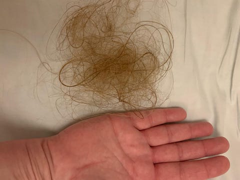 Female Hair Loss - Six Women On What Causes Hair Loss And Their Experience Female Hair Loss - Six Women On What Causes Hair Loss And Their Experience