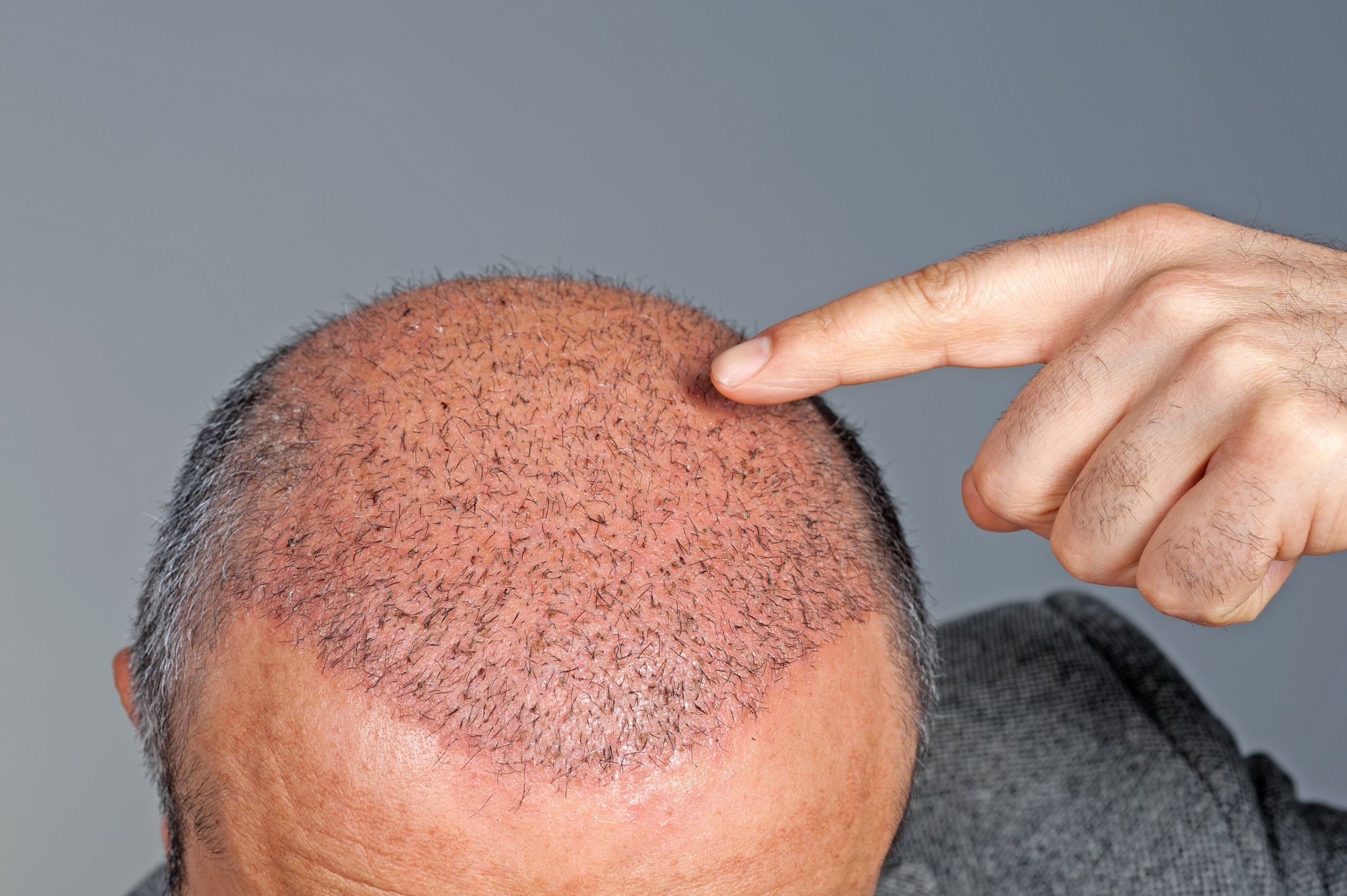 Hair Transplants: All Your Questions Answered