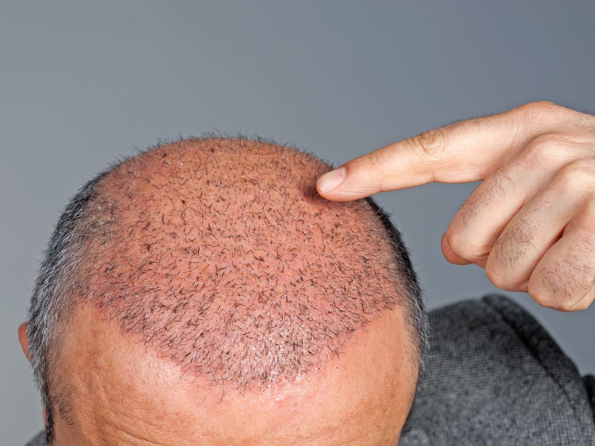 Mens Hair Transplants: Her's all you Need to Know
