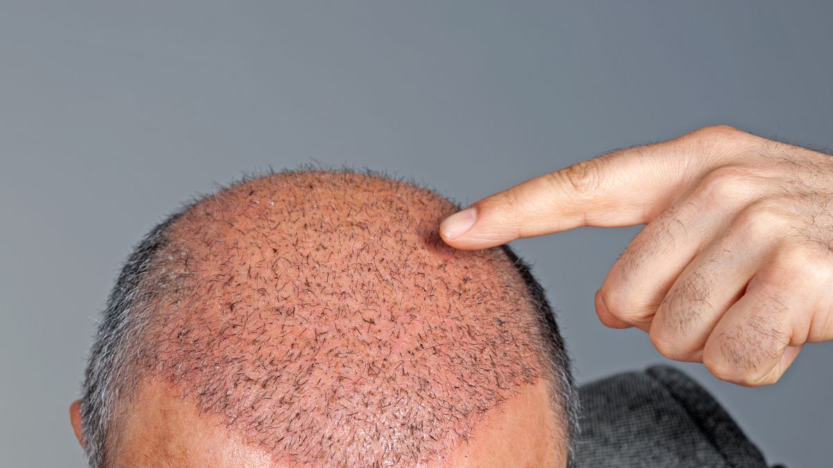 Mens Hair Transplants: Her's all you Need to Know