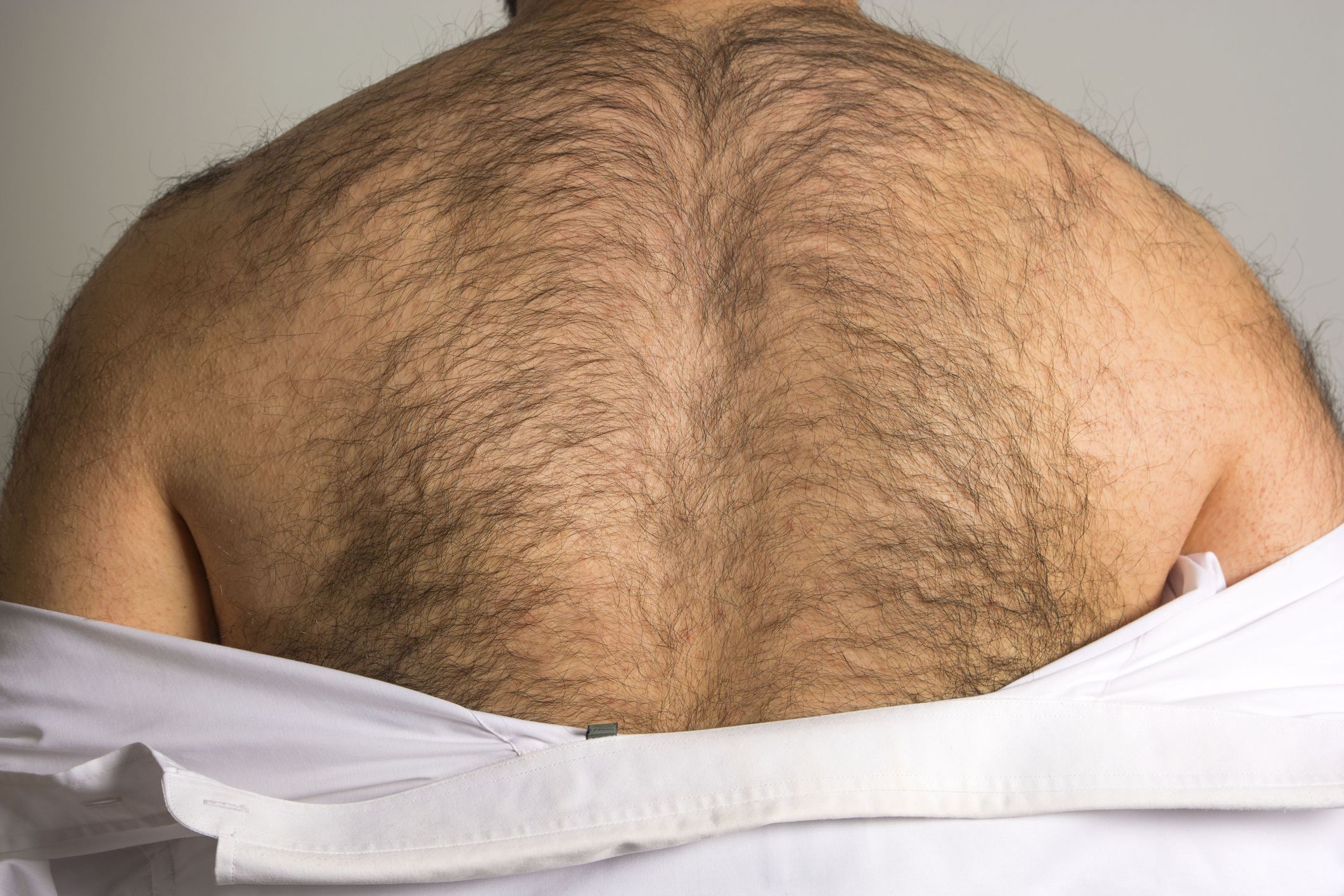 permanent back hair removal