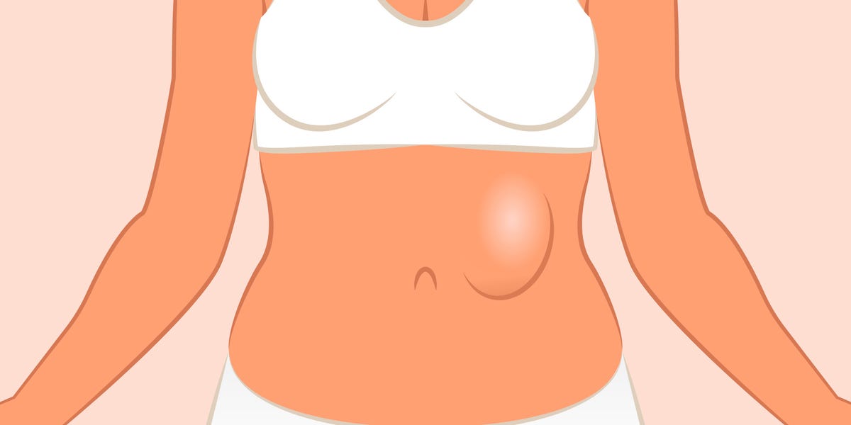 What Is a Hernia? - How To Tell If You Have A Hernia