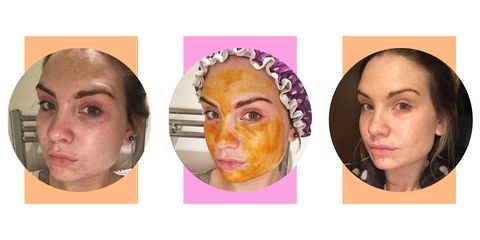 White Black Mask On Woman Porn - This DIY Honey and Turmeric Face Mask Will Fix Acne, Dark ...