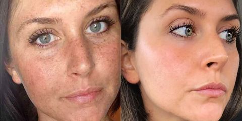 This Woman's Reddit Before-And-After Sun Damage Photo Is ...