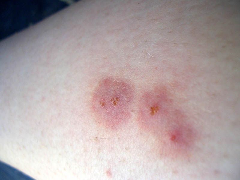 bug bites that itch for weeks