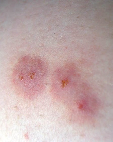 12 Common Bug Bite Pictures How To Id Insect Bites And Stings