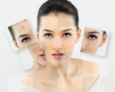 10 Tips for Acne-Prone Skin