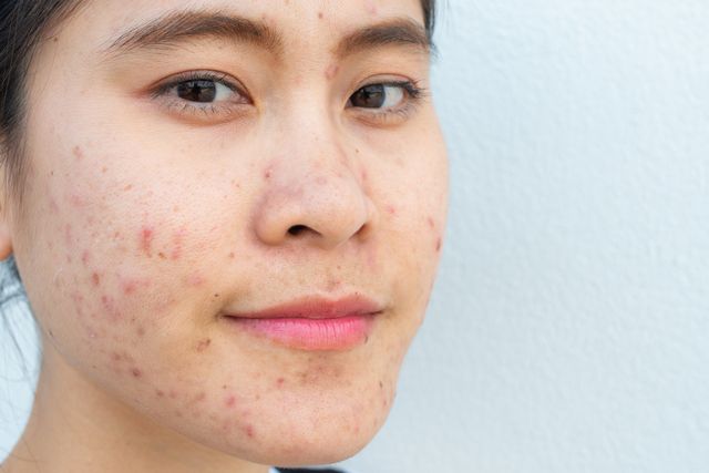 Tram Alaska Oxide Last van acné? Dit al eens geprobeerd?