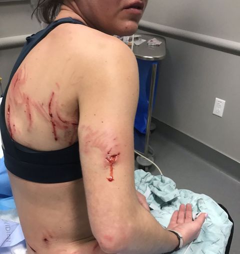 Caitlin Keen, 26, was running along Fort Worth’s Trinity Trails when a pit bull mix attacked her.