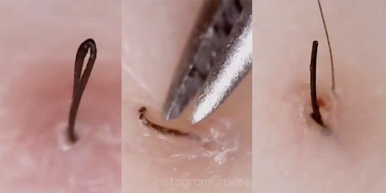Tweezist Is An Instagram Account Dedicated To Tweezing Out Ingrown